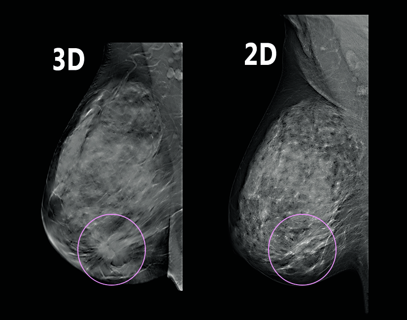 3d mammography – Diagnostic Outpatient Imaging