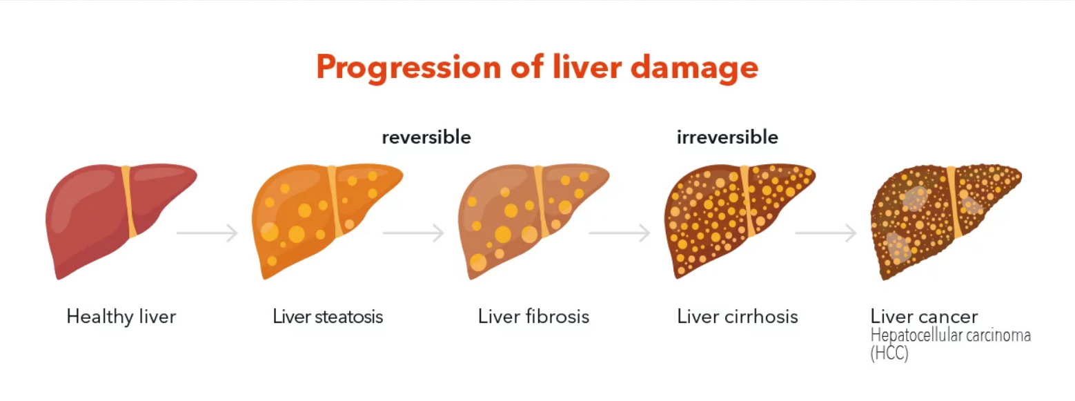 Screenshot 2022-07-22 at 12-35-32 Schema-LIVER-ENG.png (WEBP Image 1392 ...